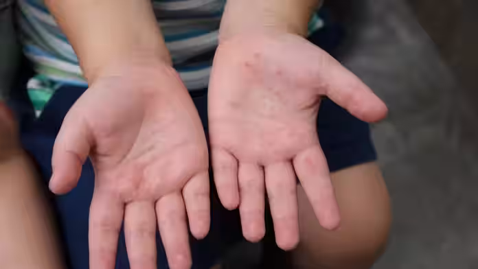Tingo María: Alerta sanitaria en colegios por brote de casos por virus Coxsackie
